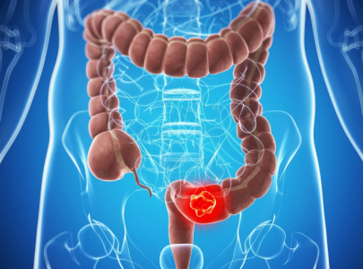 Самая коварная опухоль: Первые симптомы рака толстой кишки, которые легко пропустить — маскируются под безобидные расстройства