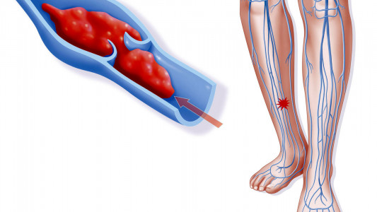 Ясно и без УЗИ: врач-флеболог объяснил, как самостоятельно выявить тромб в вене — заметит каждый