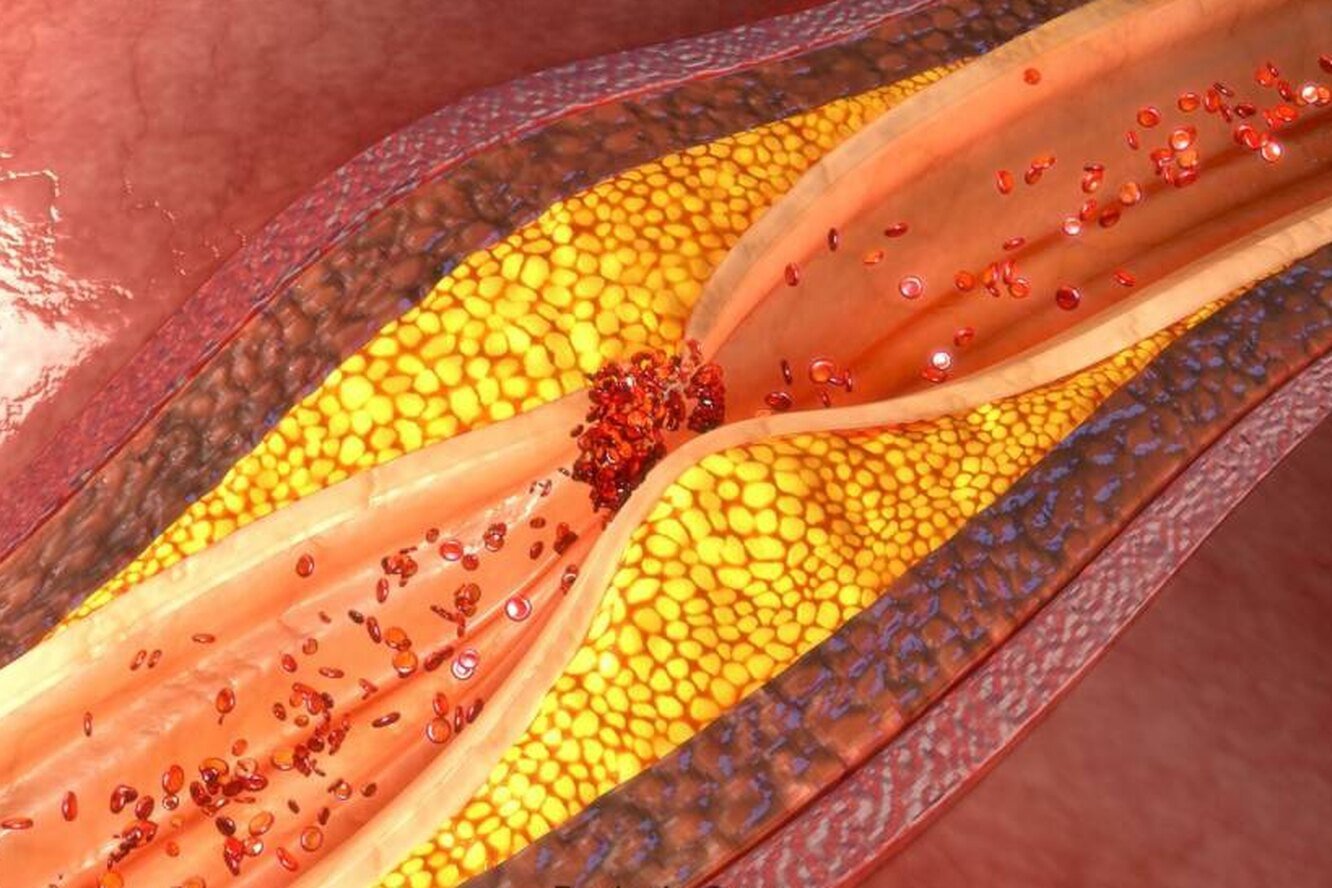 Холестерин повышается из-за трещин в сосудах: врач раскрыла, как убрать  причину проблемы без труда — и бляшек не будет - новости Хибины.ru /  Новости за март 2024