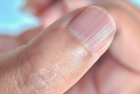 Ученые указали на симптом, который в будущем может обернуться раком — стоит обратить внимание на ногти