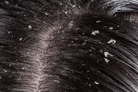 Нанесли 1 ложку на кожу головы — и перхоть исчезла: трихолог раскрыла домашний продукт — подойдет для любого типа волос