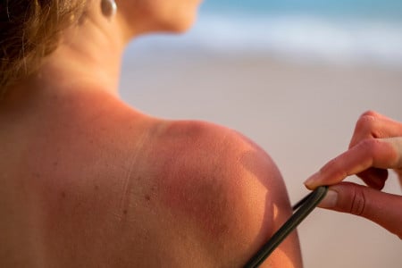Может привести к меланоме: Россиянам рассказали, чем лучше обработать кожу при солнечном ожоге — сметана не поможет